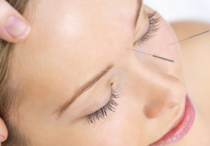 acupuntura-lifting-facial-la-cabina-de-veronica