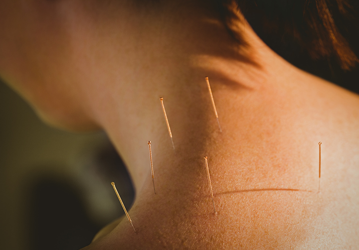 Tratamiento para el dolor con acupuntura la cabina de Verónica