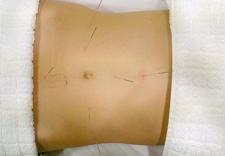 Acupuntura abdominal la Cabina de Verónica